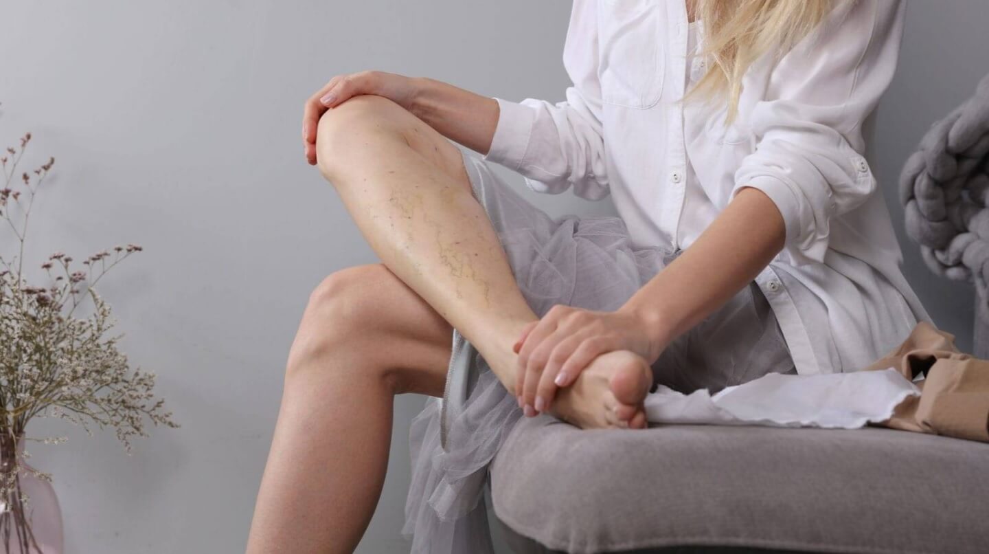 подуване разширени вени