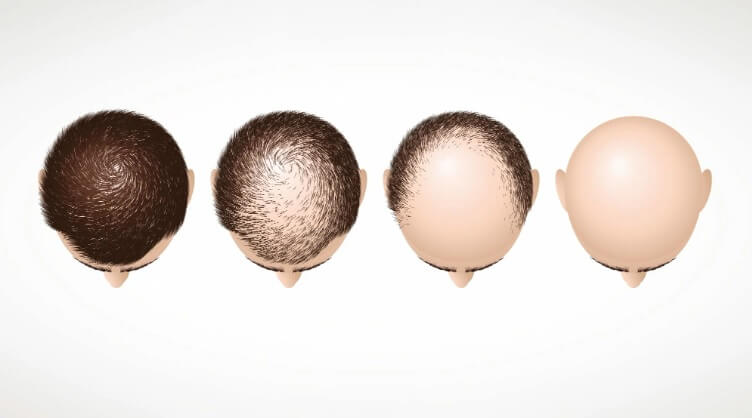 Оплешивяването